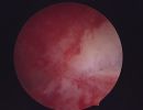 endometritis 352