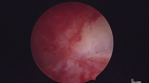endometritis 352