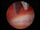 endometritis