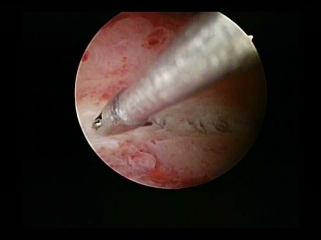 endometritis lateral adhesions
