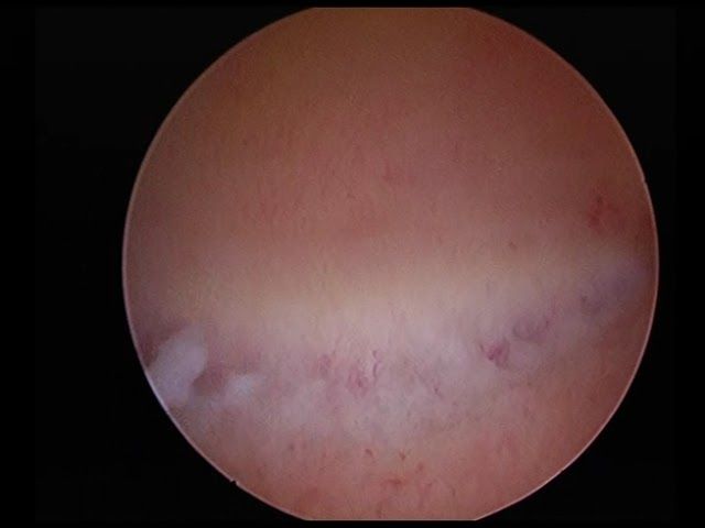 flat polyps