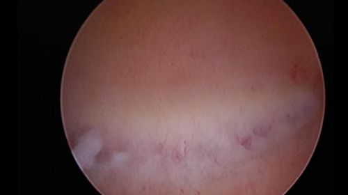 flat polyps