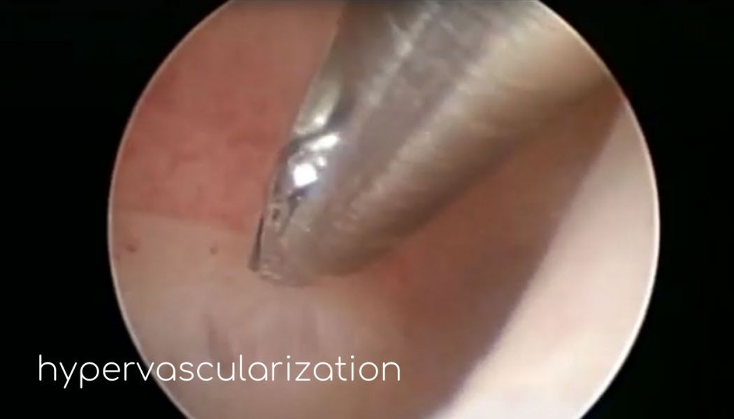 hypervascularization
