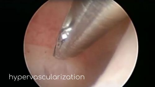 hypervascularization