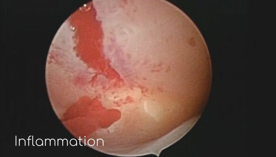 inflammation right tube