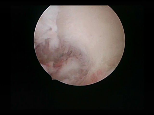 large polyp