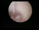 large polyp