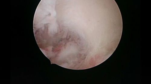large polyp