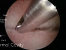 normal blocked tube