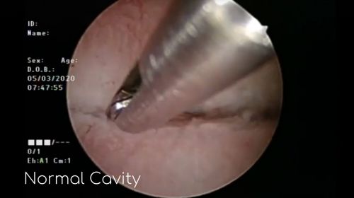 normal blocked tube