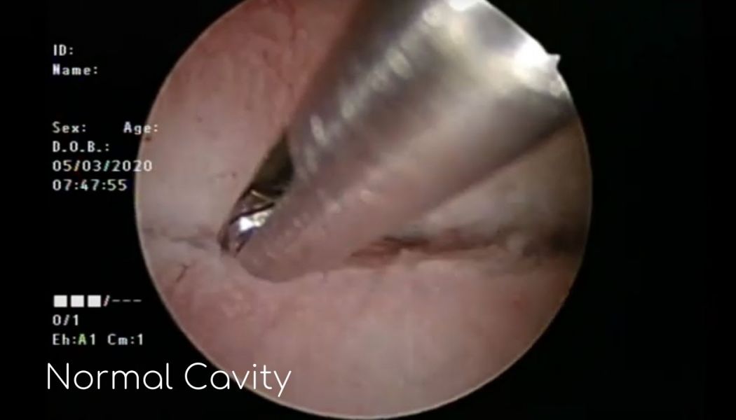 normal hypervascularity