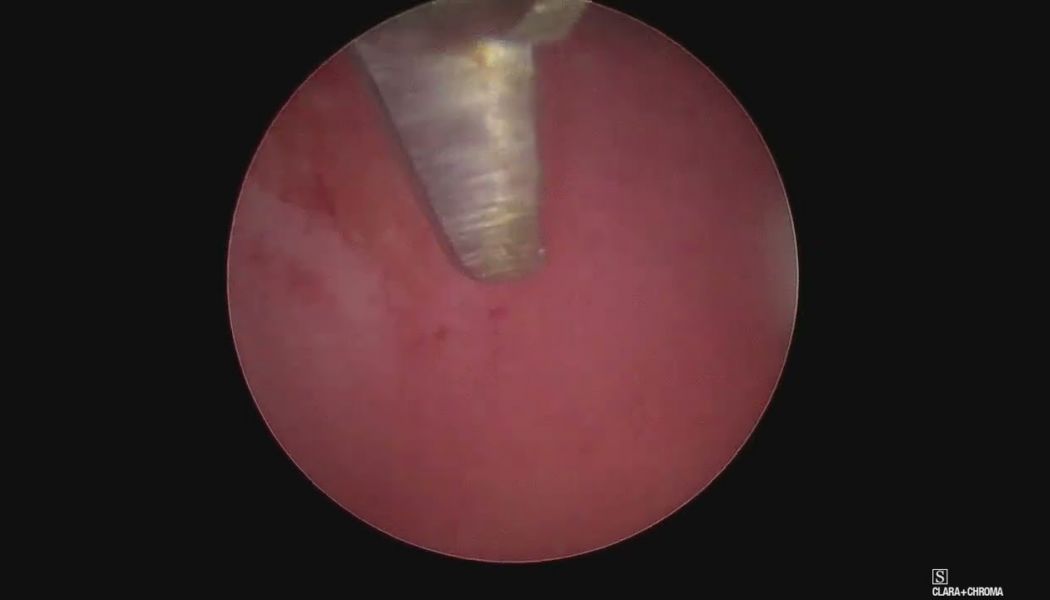 polyp huge