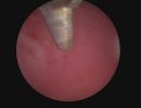 polyp huge