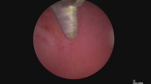 polyp huge