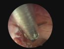 polyp nice