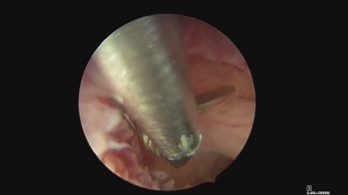 polyp nice