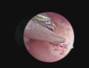 septumnd look inflammation 379