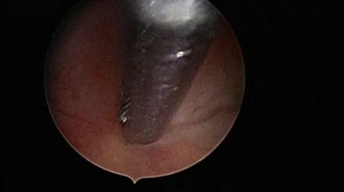 septum hypervascularization