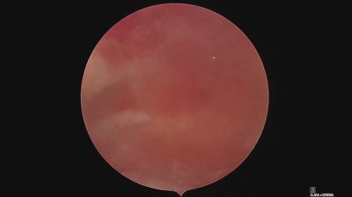 septum minor