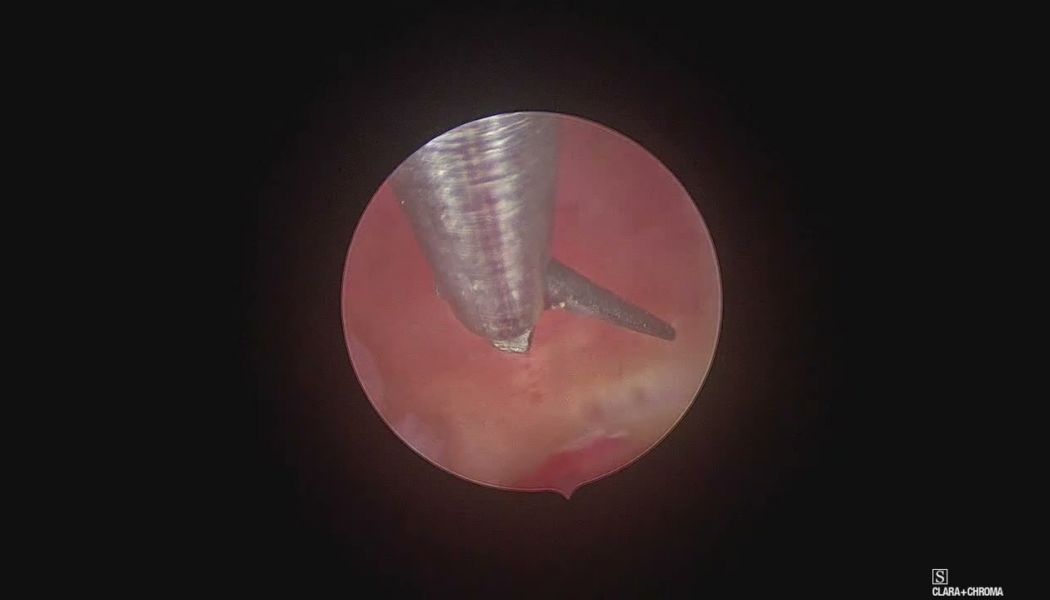small polyp mild inflammation