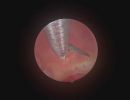 small polyp mild inflammation