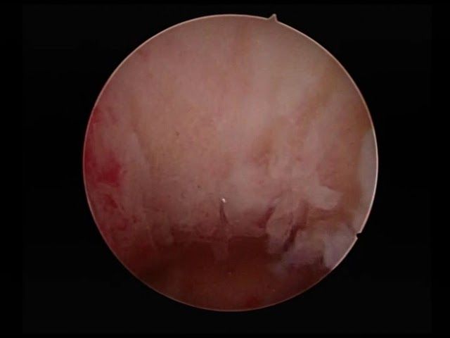 two polyps