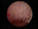 two polyps