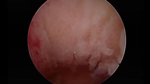 two polyps
