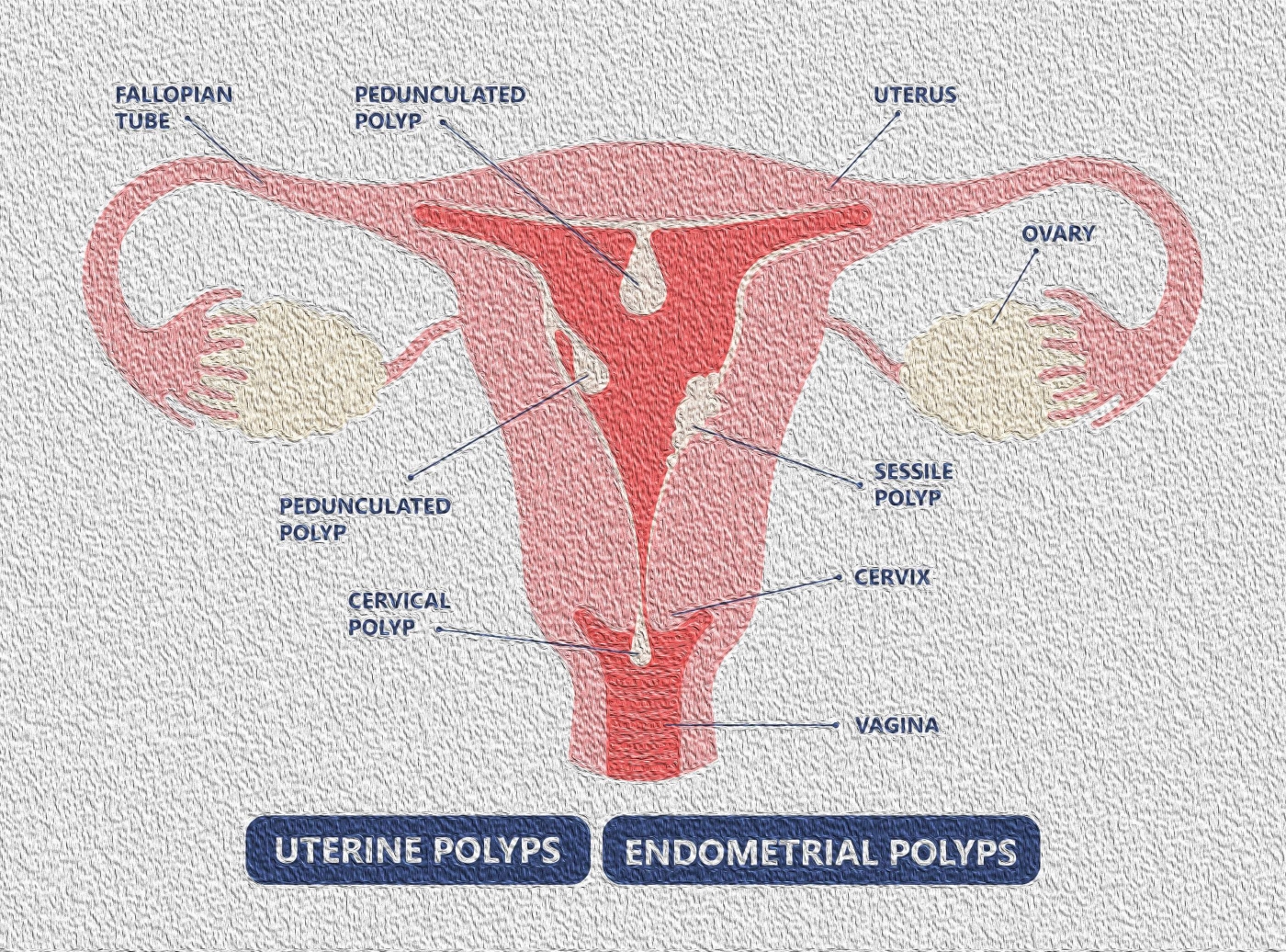 Polyp / Polypectomy