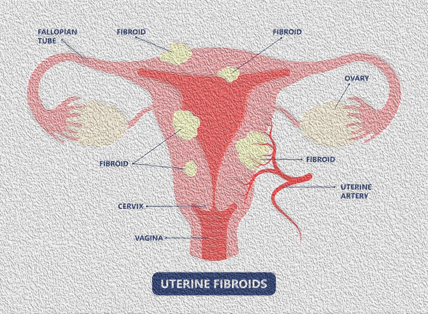 Fibroid / Myomectomy