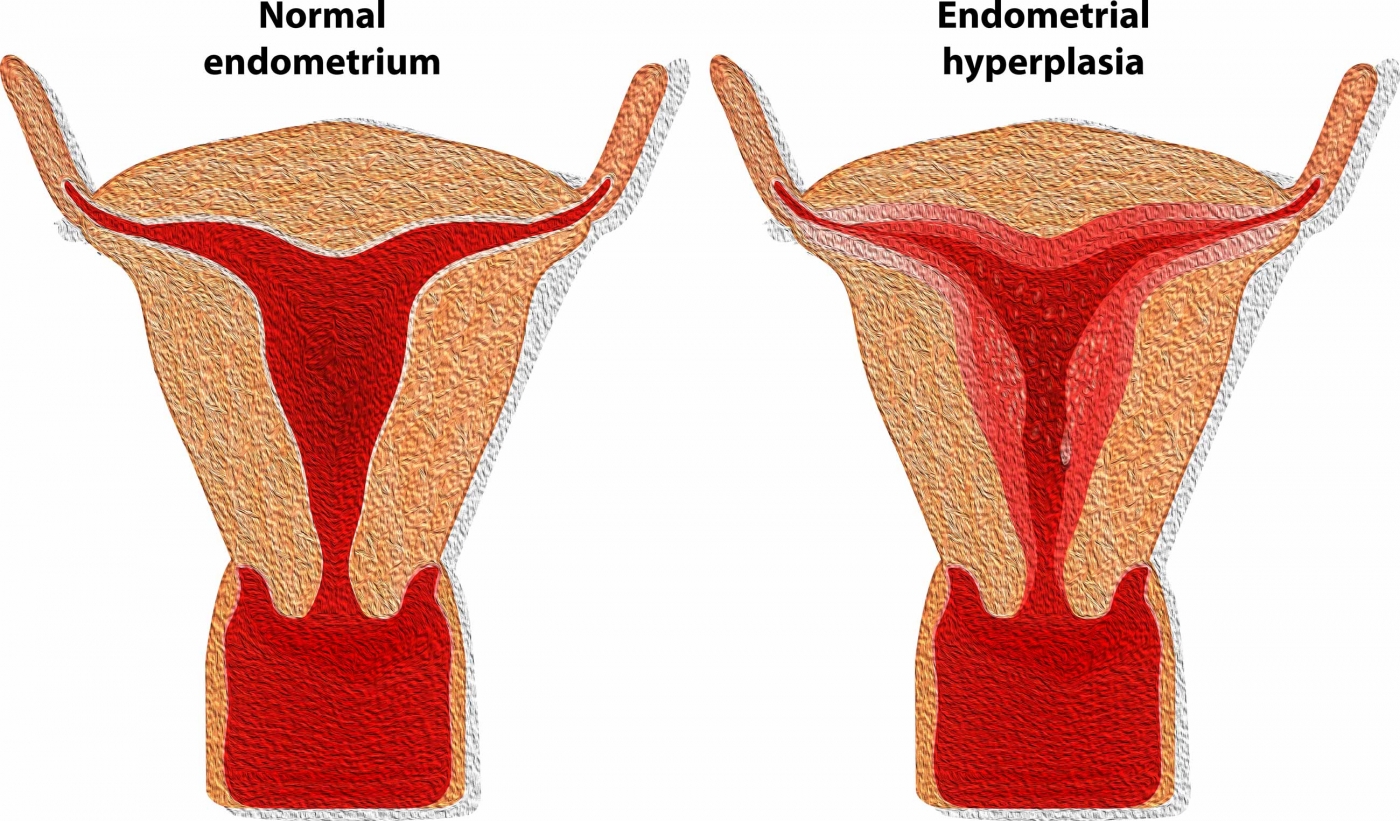Endometrial Hypertrophy/Hyperplasia